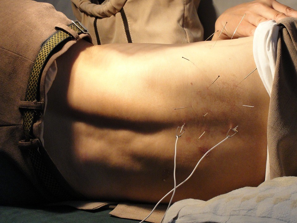Akupunktura na kręgosłup