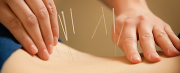 Acupuncture